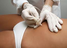 Carboxiterapia